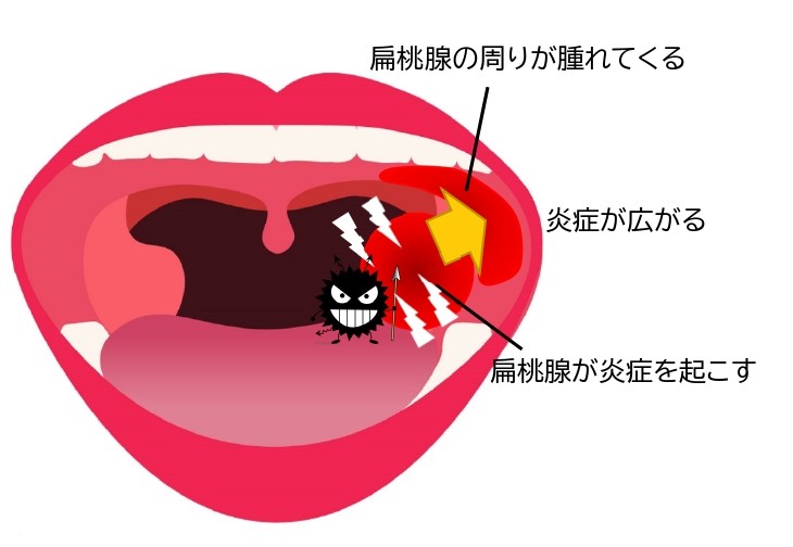 扁桃 腺 に 口内炎 原因