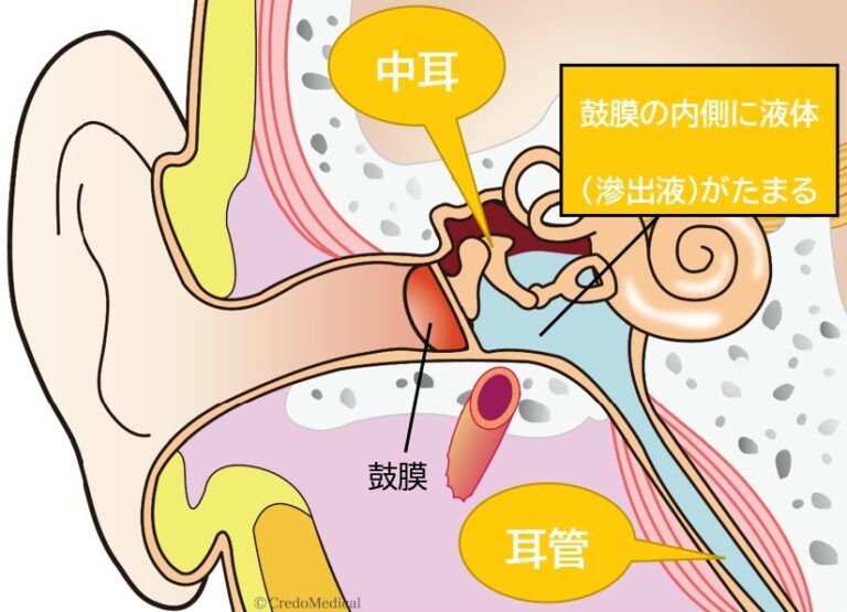 OMEはどのように治療されますか?