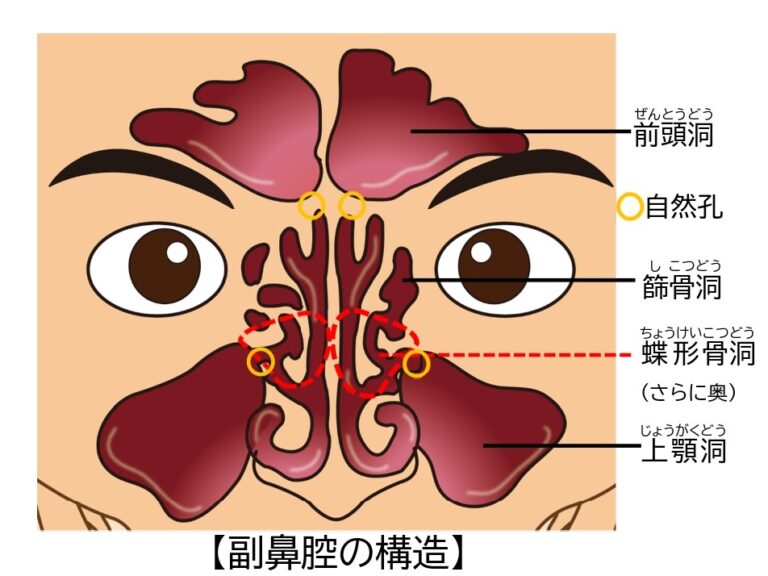 副鼻腔炎症候群による合併症