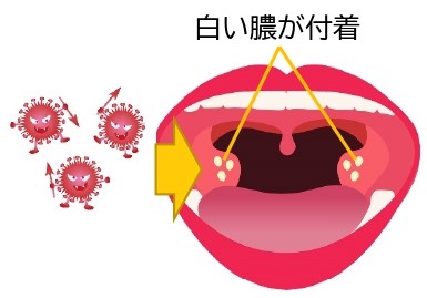 伝染性単核球症 – 伝染性単核球症 アモキシシリン , 「伝染性単核球症」の英語・英語例文・英語表現 – HCYMCB