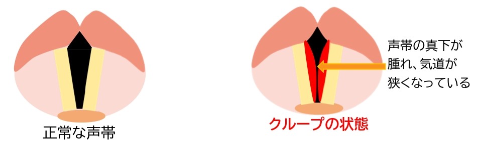 クループ(声門下喉頭炎)|のどの病気|コラム|楓みみはなのどクリニック|一宮市の耳鼻咽喉科