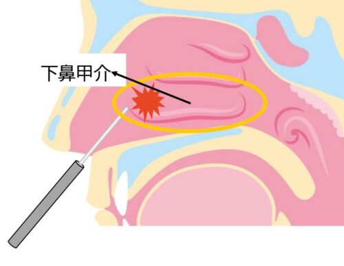 レーザー手術